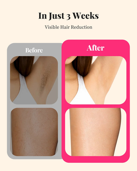 IPL Hair Removal 990000 Flash Laser Epilator For Men and Women Body Bikini Facial  Permanant Painless IPL Hair Remover Machine