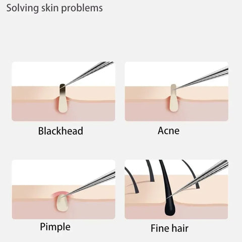 11Pcs Acne Needle Professional Tweezers Acne Remover Ultra-fine No. 5 Cell Pimples Blackhead Clip Facial Pore Cleaning Care Tool